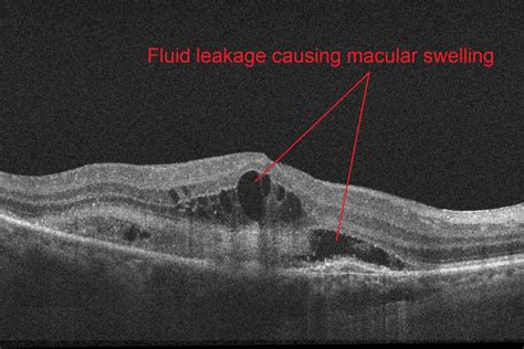 wet amd